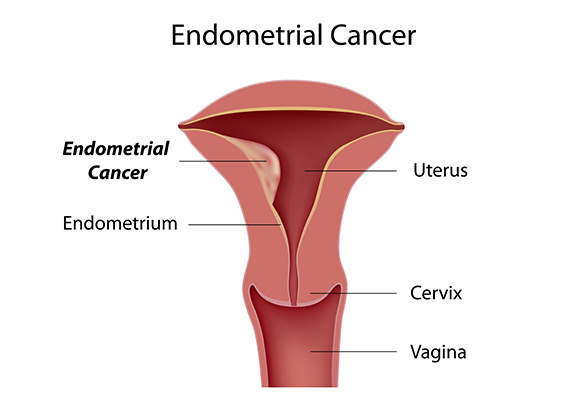 endometrial-cancer