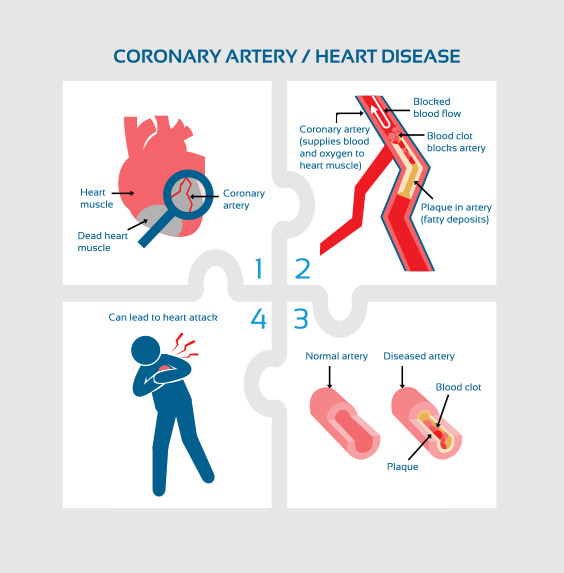 coronary-artery