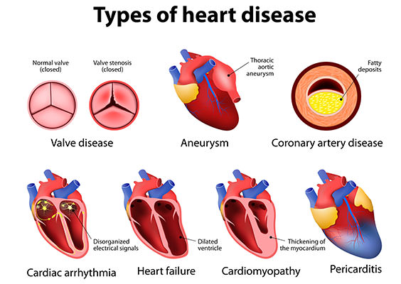 heart-disease-types