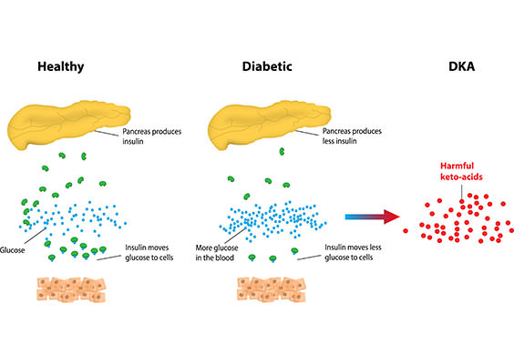 diabetic-ketoacidosis