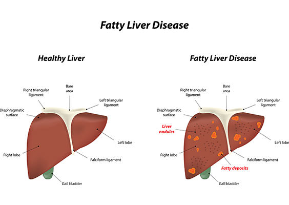 non-alcoholic-fatty-liver-disease