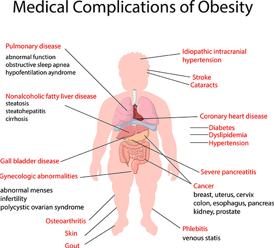 obesity-complications